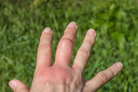 🐝 Warum reagieren Menschen allergisch auf Wespenstiche? - VapoWesp